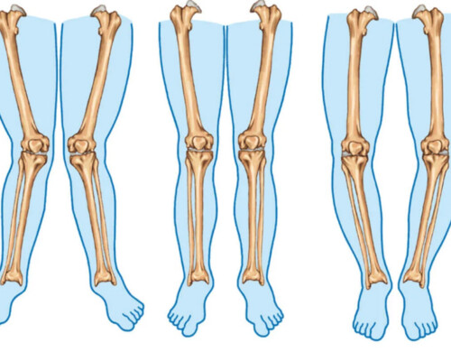 Deviaţiile de ax ale genunchilor în plan frontal