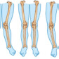 Deviaţiile de ax ale genunchilor în plan frontal